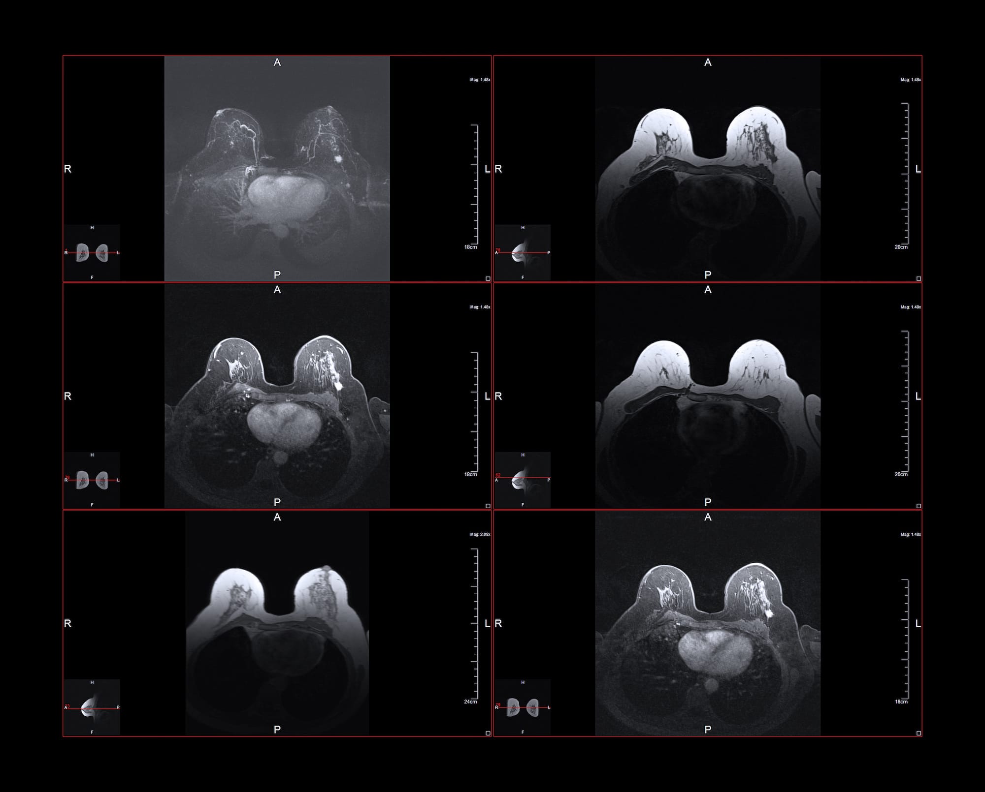 Breast MRI Touchstone Medical Imaging Dense Breast Scan